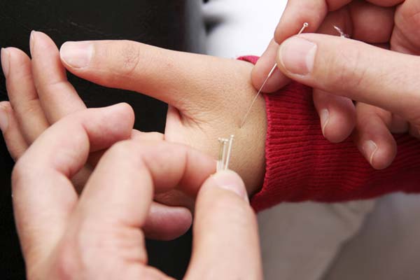 acupuncture treatment hand