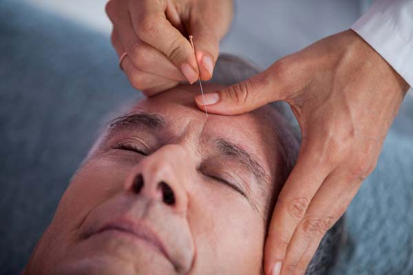 acupuncture treatment forehead