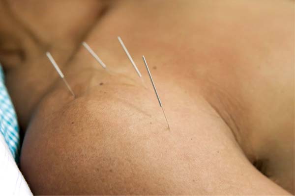 acupuncture treatment shoulder